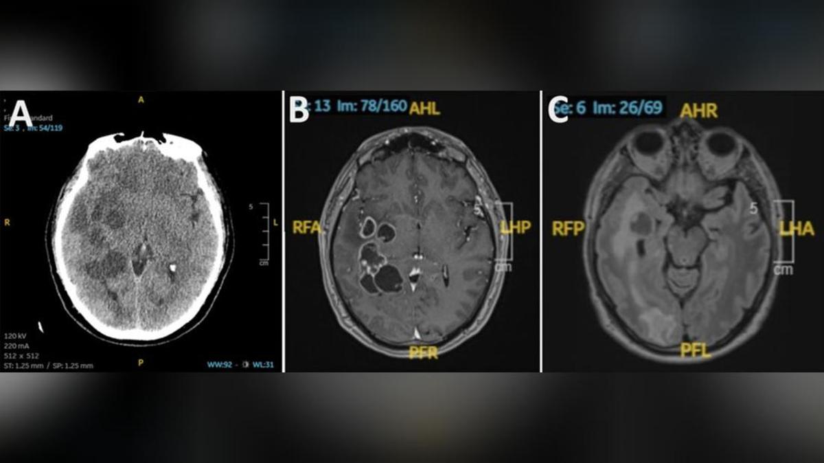 Diagnosis Keliru: Larva Cacing Pita di Otak Sempat Dikira Tumor Ganas